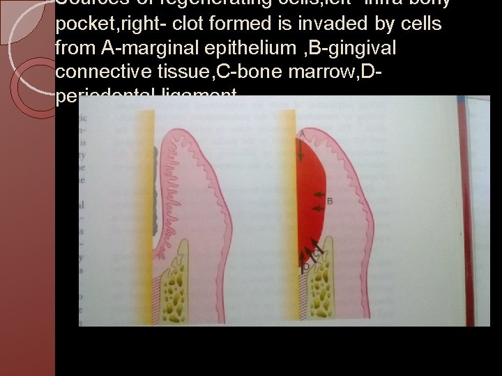 Sources of regenerating cells, left- infra bony pocket, right- clot formed is invaded by