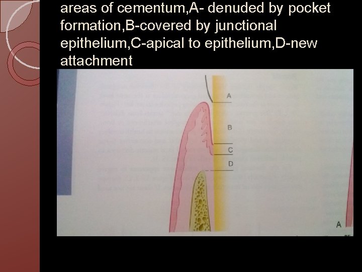 areas of cementum, A- denuded by pocket formation, B-covered by junctional epithelium, C-apical to