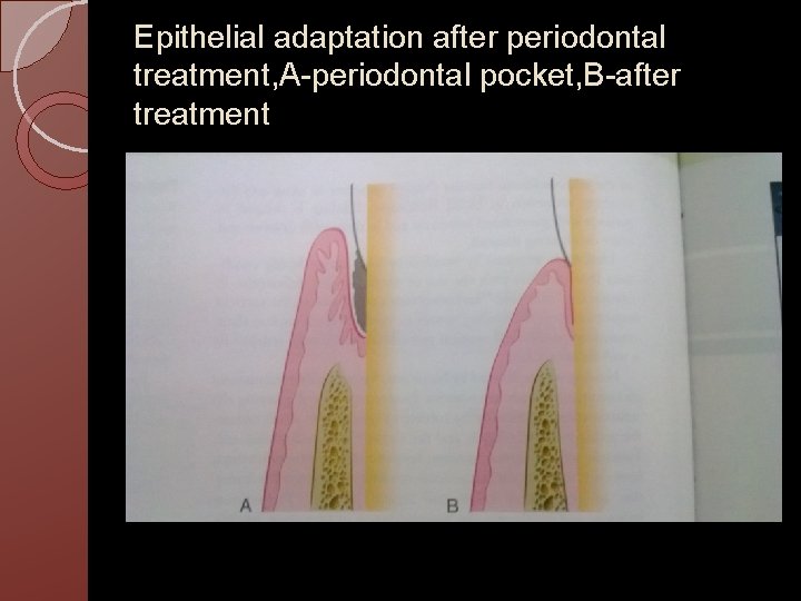Epithelial adaptation after periodontal treatment, A-periodontal pocket, B-after treatment 