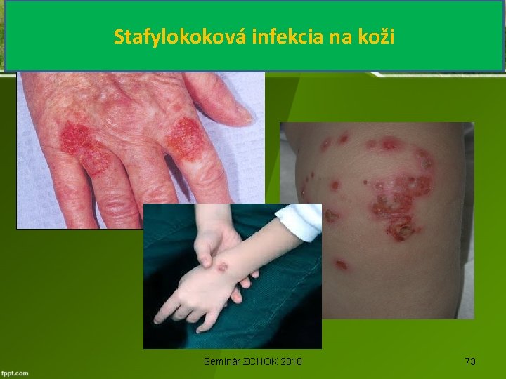 Stafylokoková infekcia na koži Seminár ZCHOK 2018 73 
