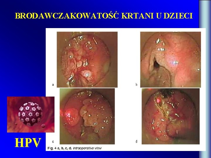 BRODAWCZAKOWATOŚĆ KRTANI U DZIECI HPV 