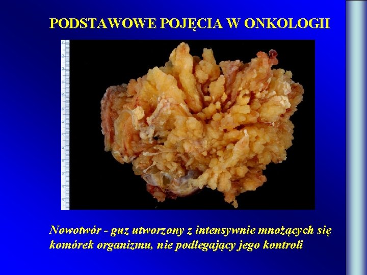 PODSTAWOWE POJĘCIA W ONKOLOGII Nowotwór - guz utworzony z intensywnie mnożących się komórek organizmu,