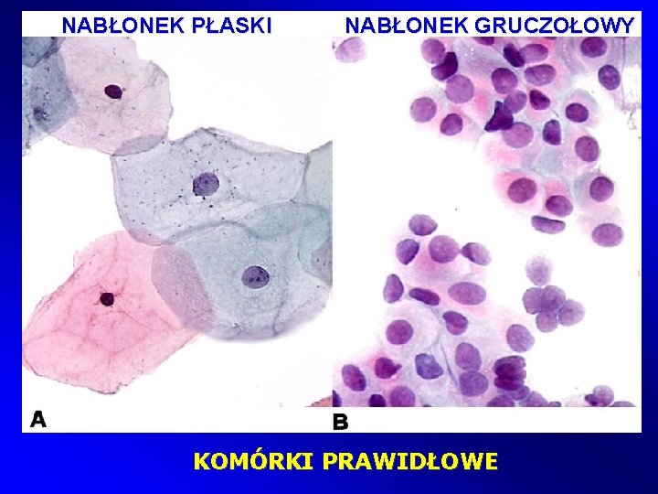  NABŁONEK PŁASKI NABŁONEK GRUCZOŁOWY KOMÓRKI PRAWIDŁOWE 