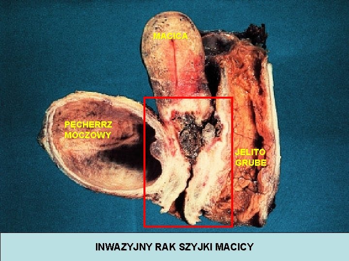 MACICA PĘCHERRZ MOCZOWY JELITO GRUBE INWAZYJNY RAK SZYJKI MACICY 