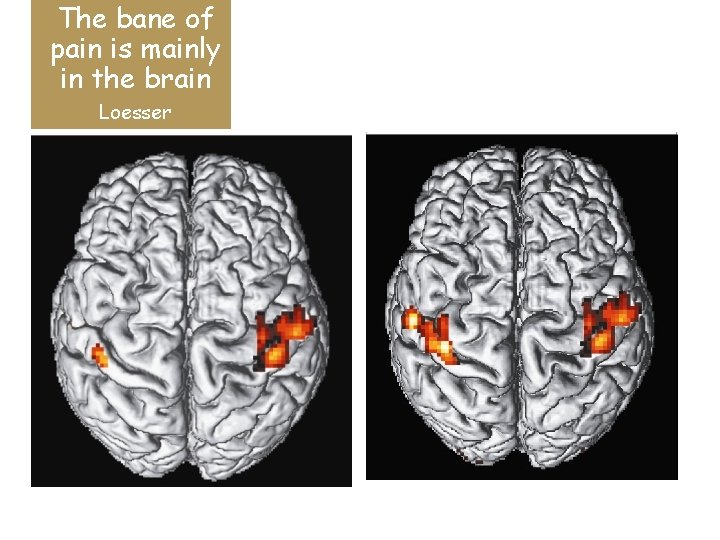 The bane of pain is mainly in the brain Loesser E VISSER CHURACK CHAIR