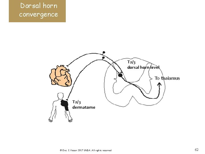 Dorsal horn convergence T 2/3 dorsal horn level T 2/3 dermatome © Eric J.