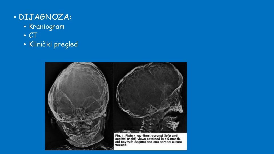  • DIJAGNOZA: • Kraniogram • CT • Klinički pregled 