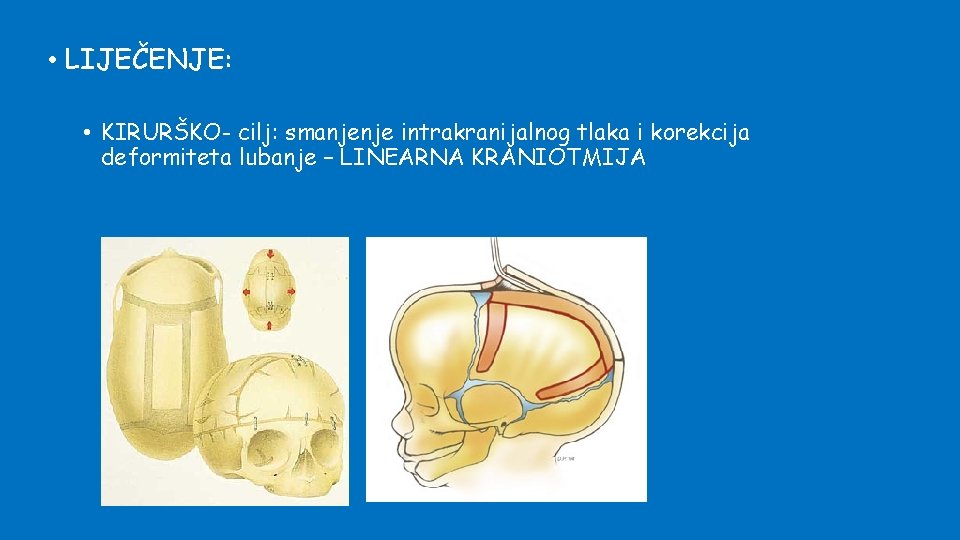  • LIJEČENJE: • KIRURŠKO- cilj: smanjenje intrakranijalnog tlaka i korekcija deformiteta lubanje –