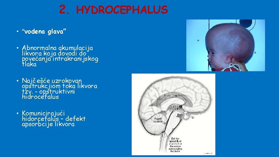 2. HYDROCEPHALUS • ”vodena glava” • Abnormalna akumulacija likvora koja dovodi do povećanja intrakranijskog