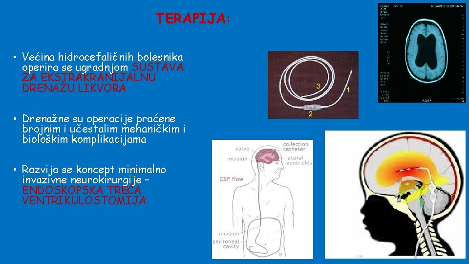 TERAPIJA: • Većina hidrocefaličnih bolesnika operira se ugradnjom SUSTAVA ZA EKSTRAKRANIJALNU DRENAŽU LIKVORA •