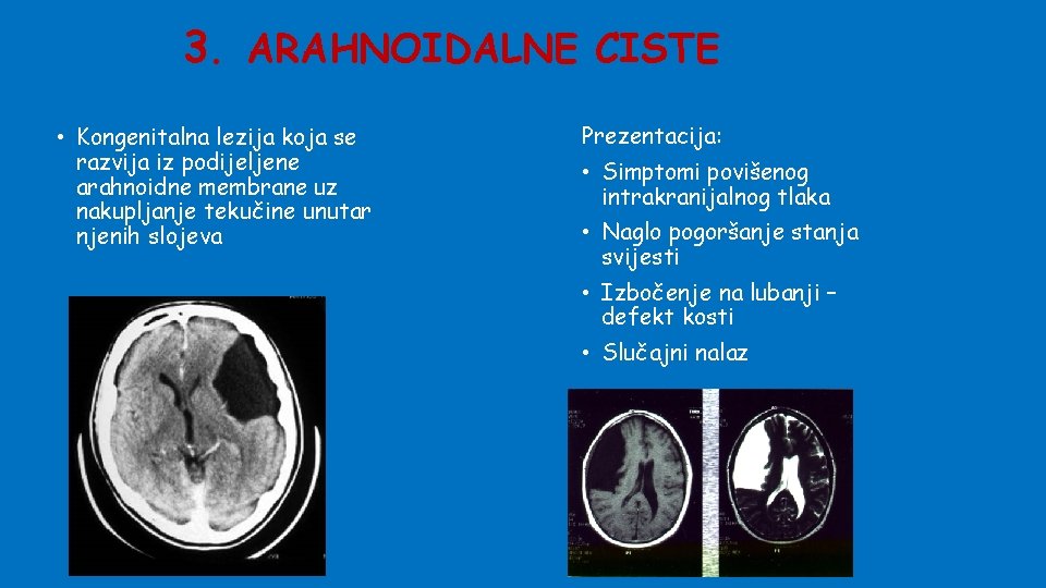 3. ARAHNOIDALNE CISTE • Kongenitalna lezija koja se razvija iz podijeljene arahnoidne membrane uz