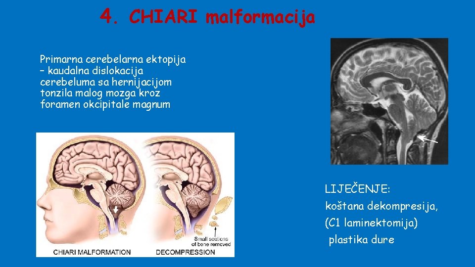 4. CHIARI malformacija Primarna cerebelarna ektopija – kaudalna dislokacija cerebeluma sa hernijacijom tonzila malog