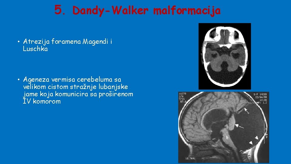 5. Dandy-Walker malformacija • Atrezija foramena Magendi i Luschka • Ageneza vermisa cerebeluma sa