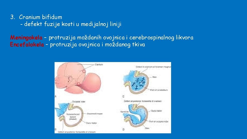 3. Cranium bifidum - defekt fuzije kosti u medijalnoj liniji Meningokela – protruzija moždanih