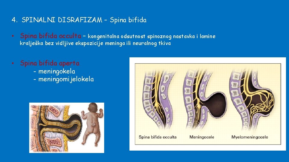 4. SPINALNI DISRAFIZAM – Spina bifida • Spina bifida occulta – kongenitalna odsutnost spinoznog