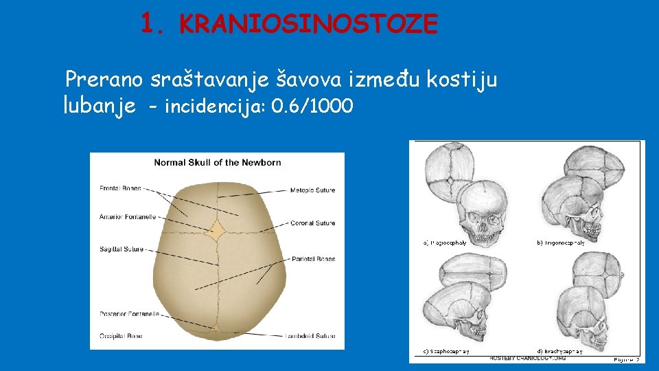 1. KRANIOSINOSTOZE Prerano sraštavanje šavova između kostiju lubanje - incidencija: 0. 6/1000 