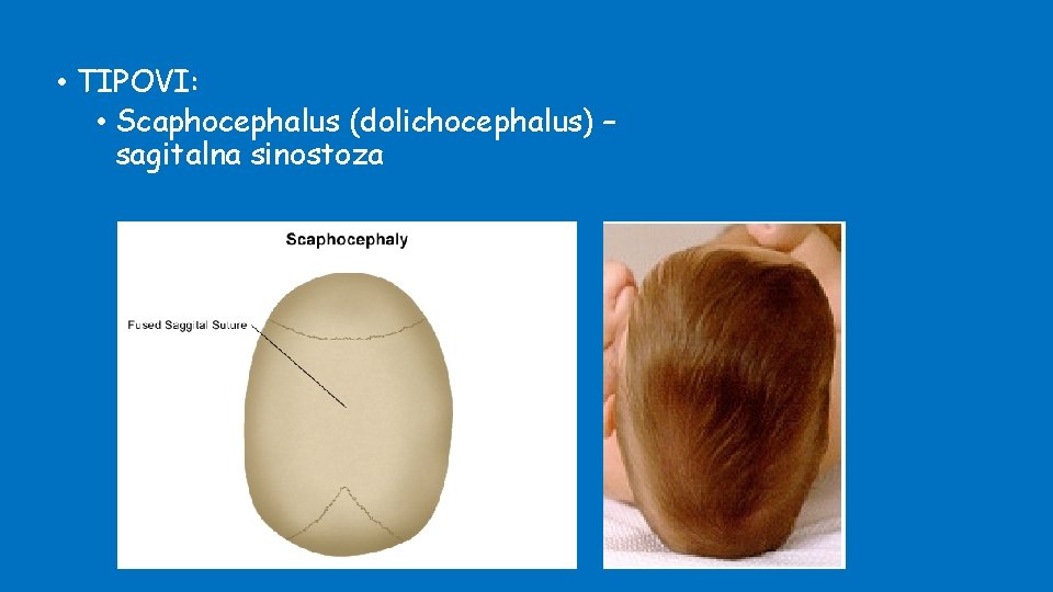  • TIPOVI: • Scaphocephalus (dolichocephalus) – sagitalna sinostoza 