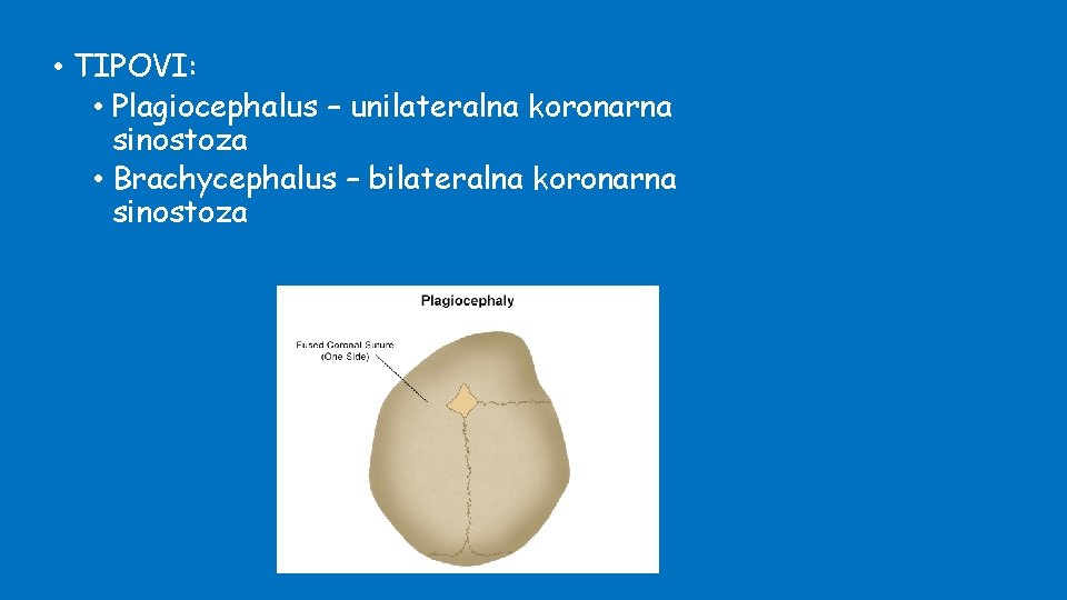  • TIPOVI: • Plagiocephalus – unilateralna koronarna sinostoza • Brachycephalus – bilateralna koronarna