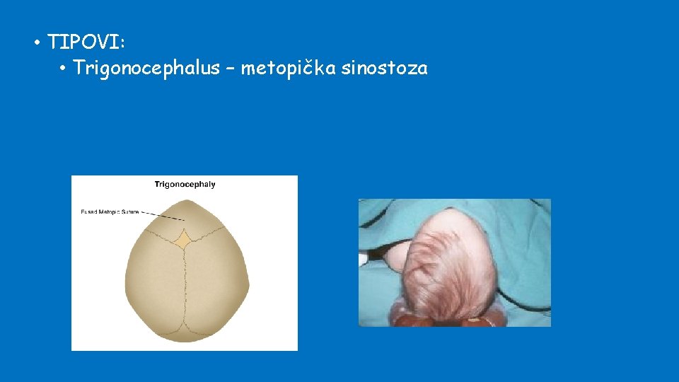  • TIPOVI: • Trigonocephalus – metopička sinostoza 