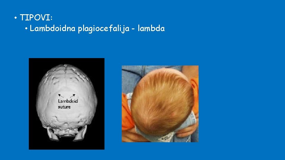  • TIPOVI: • Lambdoidna plagiocefalija - lambda 