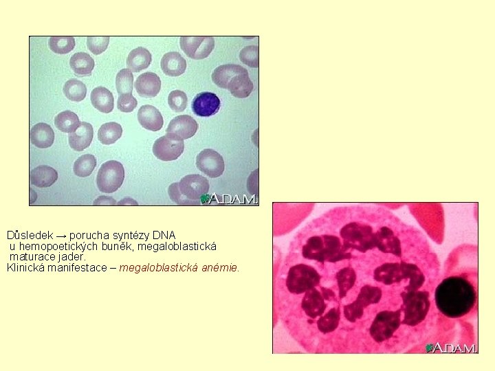 Důsledek → porucha syntézy DNA u hemopoetických buněk, megaloblastická maturace jader. Klinická manifestace –