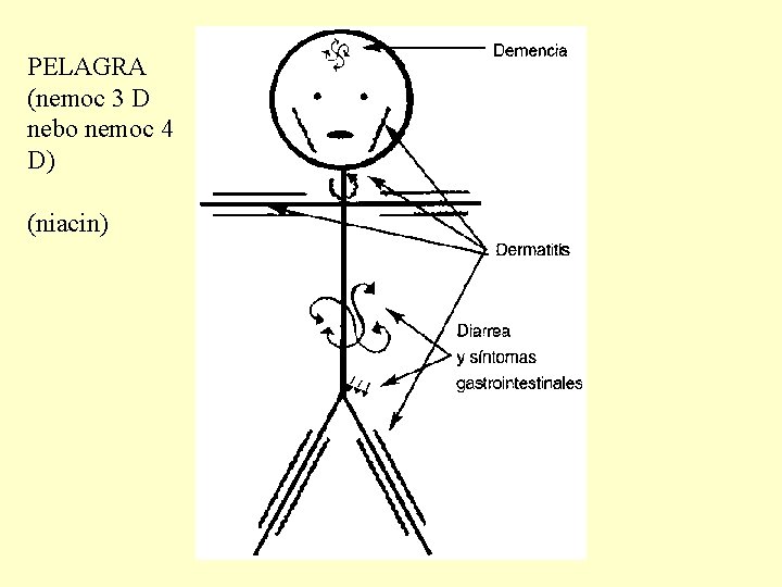 PELAGRA (nemoc 3 D nebo nemoc 4 D) (niacin) 