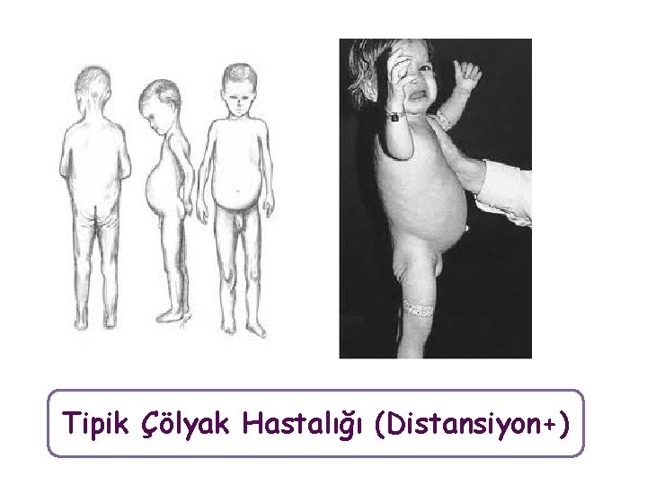 Tipik Çölyak Hastalığı (Distansiyon+) 