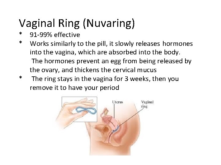 Vaginal Ring (Nuvaring) * * * 91 -99% effective Works similarly to the pill,