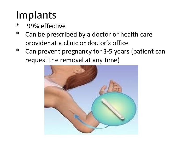 Implants * 99% effective * Can be prescribed by a doctor or health care