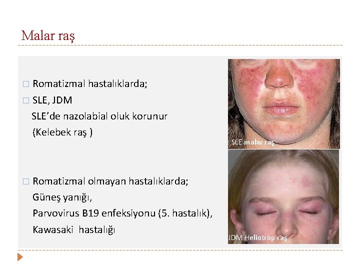 Malar raş � Romatizmal hastalıklarda; � SLE, JDM SLE’de nazolabial oluk korunur (Kelebek raş