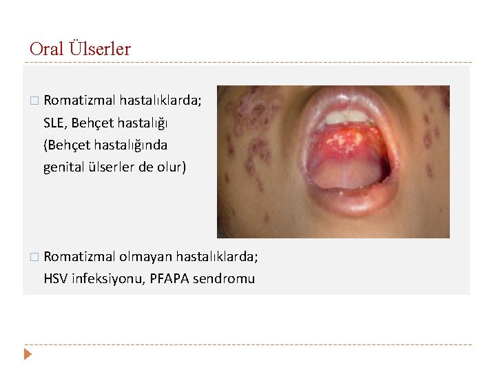 Oral Ülserler � Romatizmal hastalıklarda; SLE, Behçet hastalığı (Behçet hastalığında genital ülserler de olur)