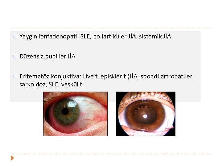 � Yaygın lenfadenopati: SLE, poliartiküler JİA, sistemik JİA � Düzensiz pupiller JİA � Eritematöz