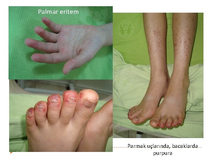 Palmar eritem Parmak uçlarında, bacaklarda purpura 