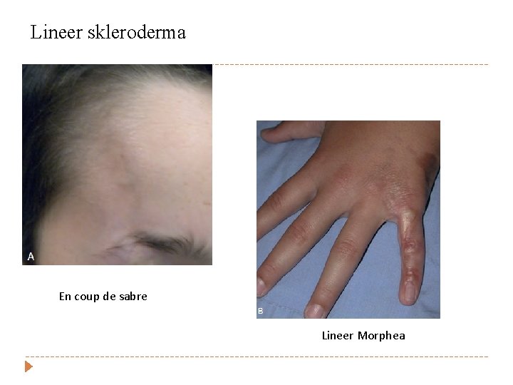 Lineer skleroderma En coup de sabre Lineer Morphea 