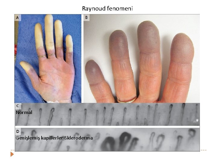 Raynoud fenomeni Normal Genişlemiş kapillerler-Skleroderma 
