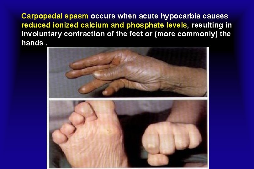 Carpopedal spasm occurs when acute hypocarbia causes reduced ionized calcium and phosphate levels, resulting