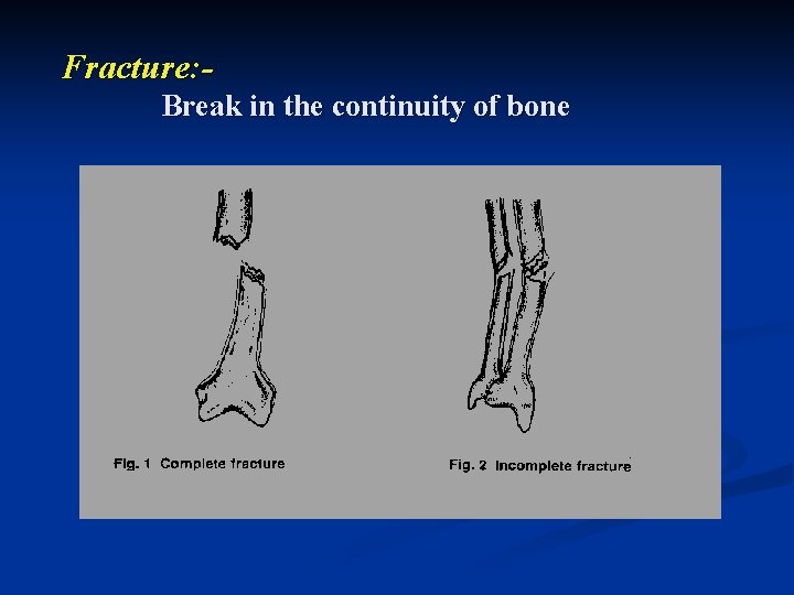 Fracture: - Break in the continuity of bone 