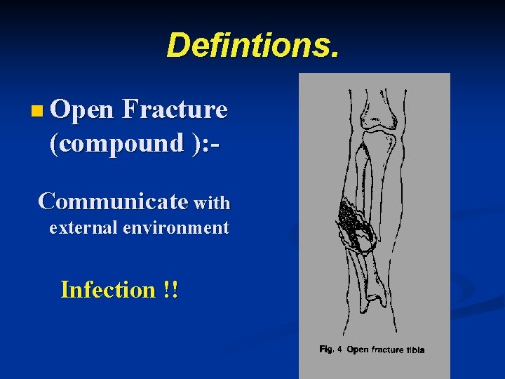 Defintions. n Open Fracture (compound ): Communicate with external environment Infection !! 