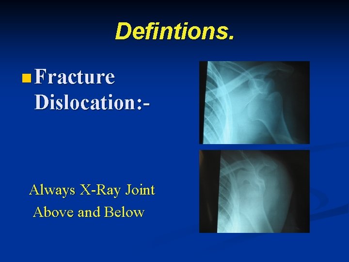 Defintions. n Fracture Dislocation: Always X-Ray Joint Above and Below 