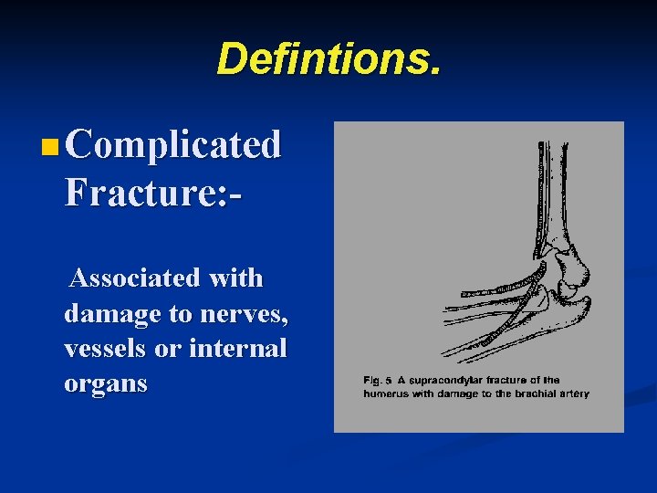 Defintions. n Complicated Fracture: Associated with damage to nerves, vessels or internal organs 