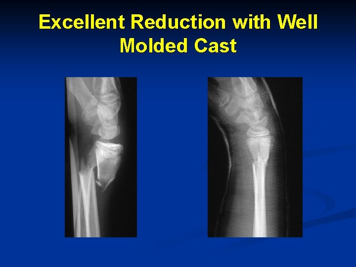 Excellent Reduction with Well Molded Cast 