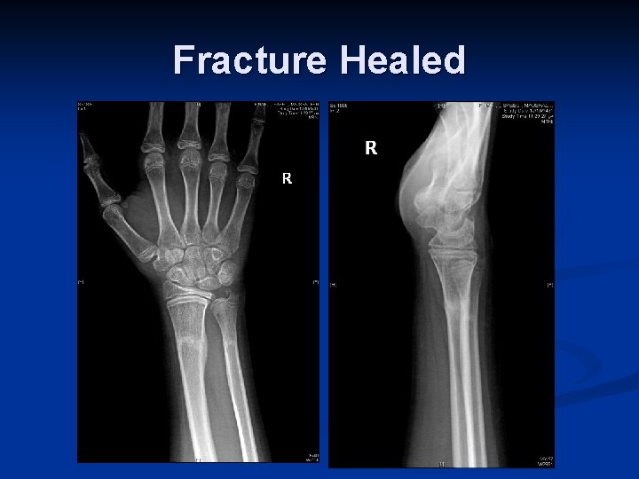 Fracture Healed 