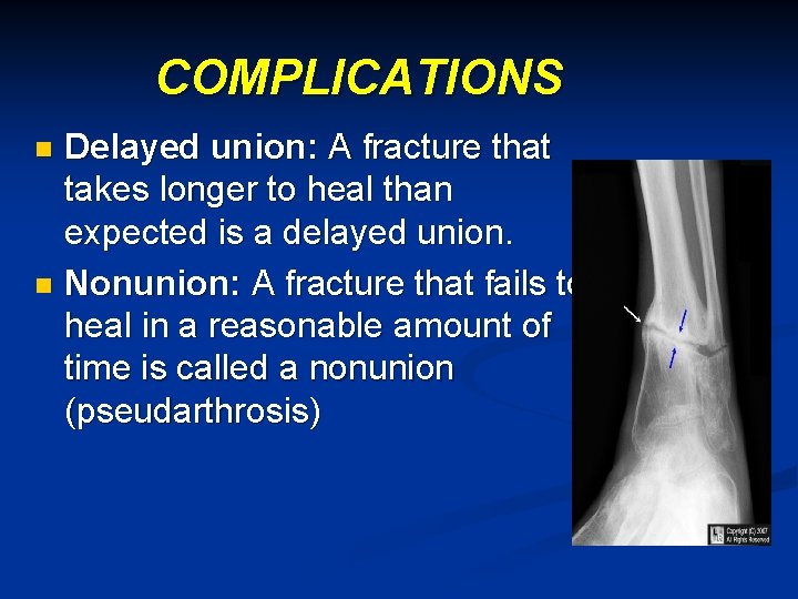 COMPLICATIONS Delayed union: A fracture that takes longer to heal than expected is a
