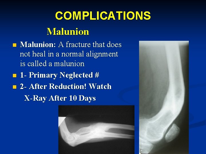 COMPLICATIONS Malunion: A fracture that does not heal in a normal alignment is called