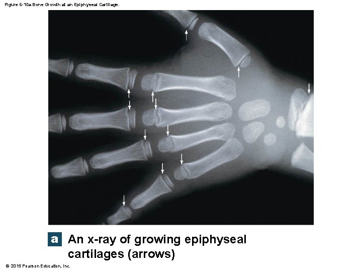 Figure 6 -10 a Bone Growth at an Epiphyseal Cartilage. a An x-ray of