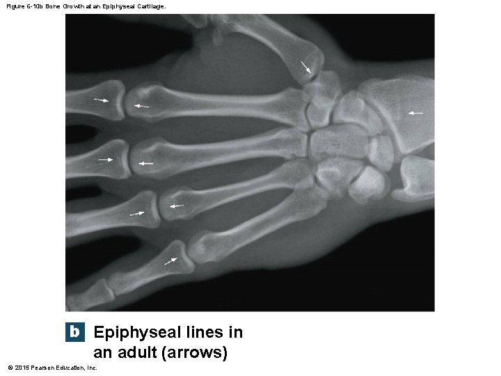 Figure 6 -10 b Bone Growth at an Epiphyseal Cartilage. b Epiphyseal lines in
