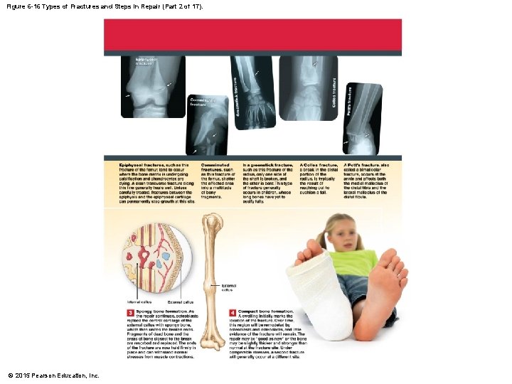 Figure 6 -16 Types of Fractures and Steps in Repair (Part 2 of 17).