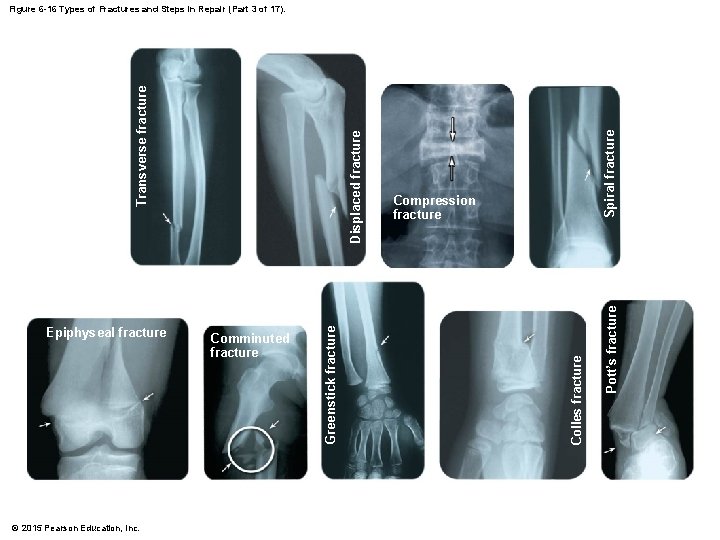 © 2015 Pearson Education, Inc. Spiral fracture Pott’s fracture Compression fracture Colles fracture Comminuted