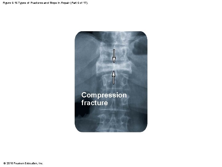 Figure 6 -16 Types of Fractures and Steps in Repair (Part 6 of 17).