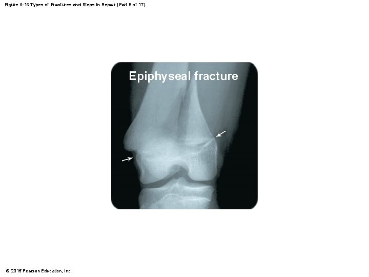Figure 6 -16 Types of Fractures and Steps in Repair (Part 8 of 17).